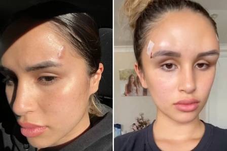 Na web, Jessie Carr foi comparada ao personagem Megamente. Cirurgia plástica malsucedida deforma rosto de modelo australiana; veja