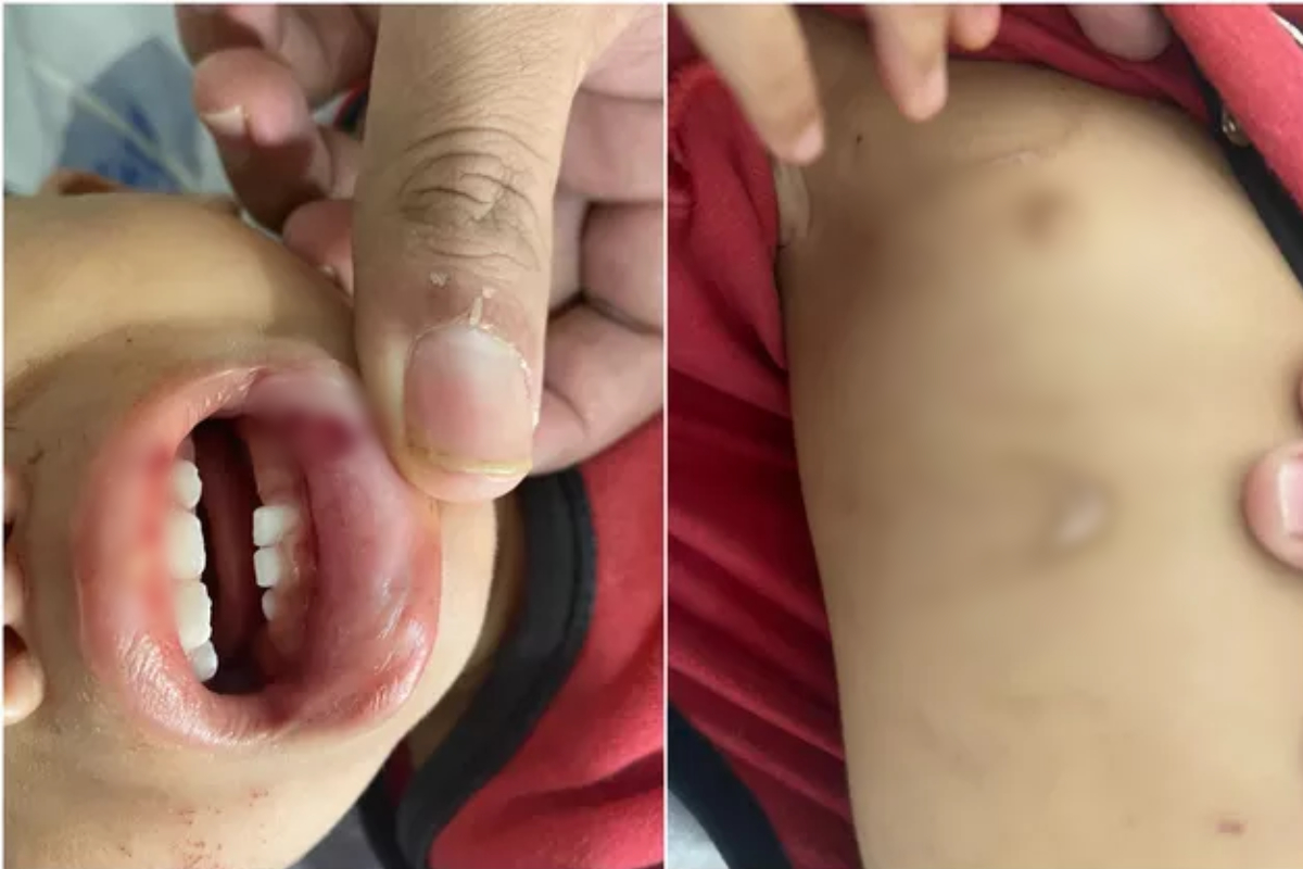 A Polícia Civil investiga um possível crime de maus-tratos contra um bebê de 1 ano e 2 meses, na cidade de Goianira. Caso foi descoberto na manhã de quarta-feira (28), depois que a tia da criança a levou para um hospital com vários ferimentos pelo corpo, traumatismo craniano e sinais de tortura. O Conselho Tutelar informou à polícia que a mulher contou que o menino se machucou porque caiu de uma escada. No entanto, médico desconfiou que muitas lesões não eram recentes.