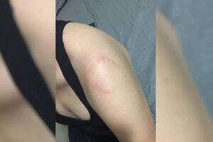 Um homem, de 31 anos, é investigado por morder o braço de uma mulher dentro de uma academia na cidade de Rio Verde. (Foto: reprodução)