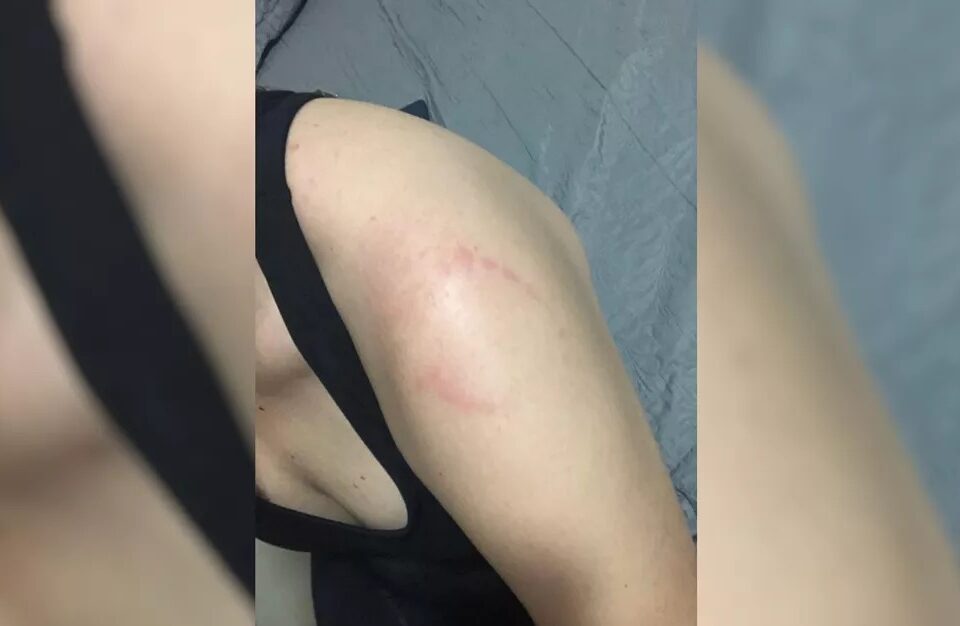 Um homem, de 31 anos, é investigado por morder o braço de uma mulher dentro de uma academia na cidade de Rio Verde. (Foto: reprodução)
