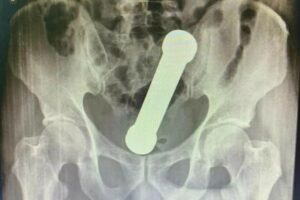 Médicos encontram peso de academia dentro de paciente em Manaus