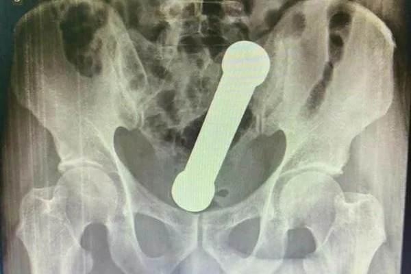 Médicos encontram peso de academia dentro de paciente em Manaus