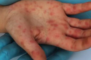 A Secretaria de Estado da Saúde de Goiás (SES-GO) descartou casos de sarampo em duas crianças após exames laboratoriais. (Foto: divulgação/Febrasgo.org)