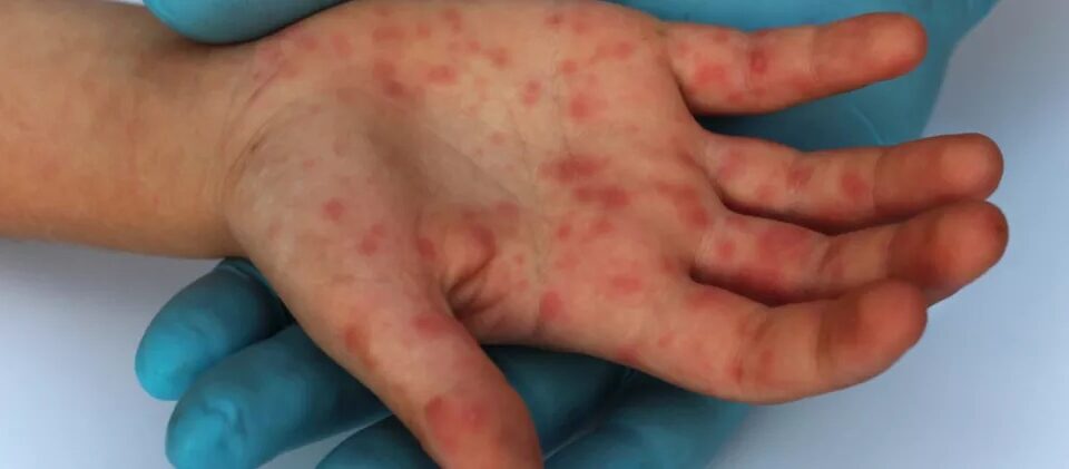A Secretaria de Estado da Saúde de Goiás (SES-GO) descartou casos de sarampo em duas crianças após exames laboratoriais. (Foto: divulgação/Febrasgo.org)