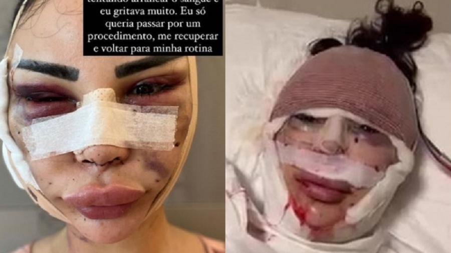 A atriz e modelo brasileira Jennifer Pamplona, 29, compartilhou uma sequência de fotos em que aparece com o rosto machucado. (Foto: reprodução/redes sociais)
