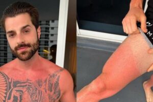 Alok posta foto com corpo queimado de sol e reclama: "Nunca aprendo"