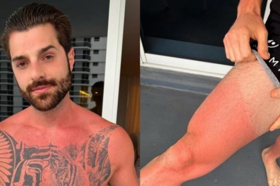 Alok posta foto com corpo queimado de sol e reclama: 