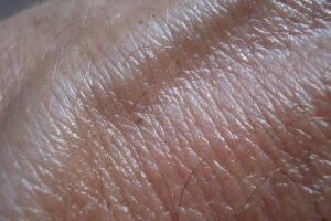 UFF ensinará técnica que permite 100% de cura em cânceres de pele