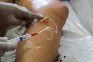 Doença venosa crônica é fator de risco para problemas cardiovasculares