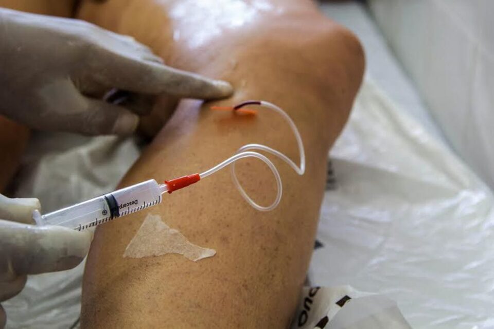 Doença venosa crônica é fator de risco para problemas cardiovasculares