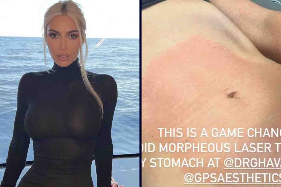 Kim Kardashian faz procedimento para 'apertar' estômago: 'Doloroso, mas vale'