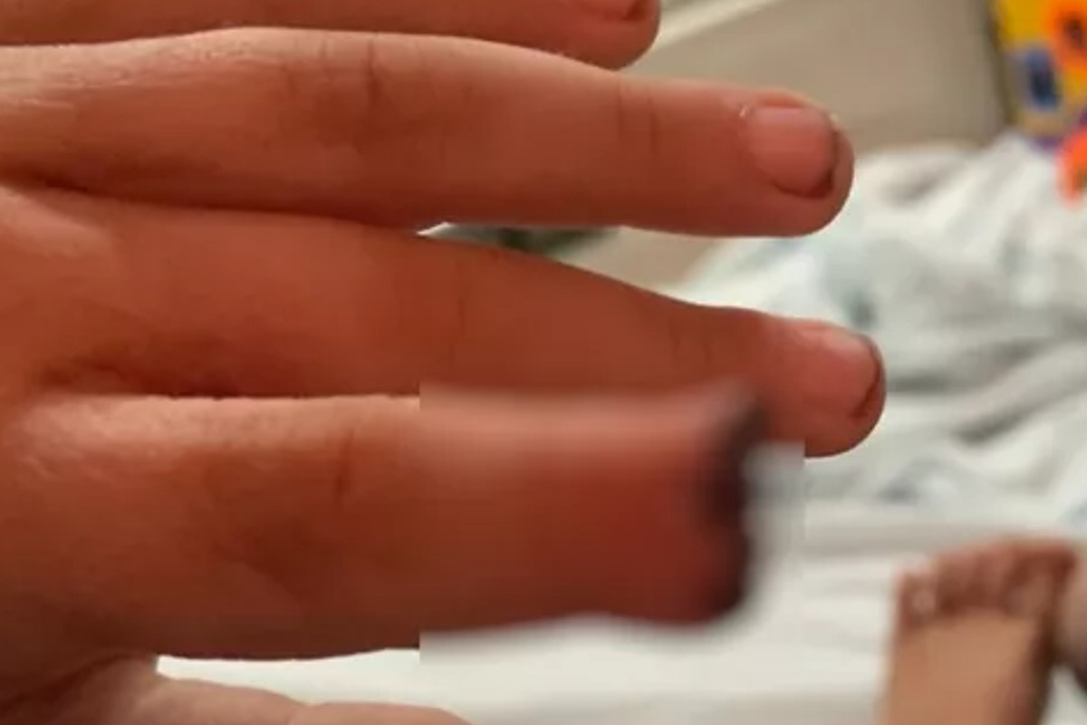 Criança tem ponta do dedo amputada após ter mão prensada em armário pela professora em Goiânia