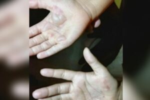 Mãe queima mãos das filhas como punição por comerem leite condensado, em Rio Verde (GO)