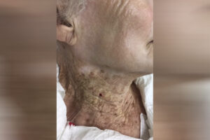 Imagem mostra diferença entre rosto preservado por protetor solar e pescoço enrugado com danos de luz solar (Foto: Divulgação/C Posch 2021)