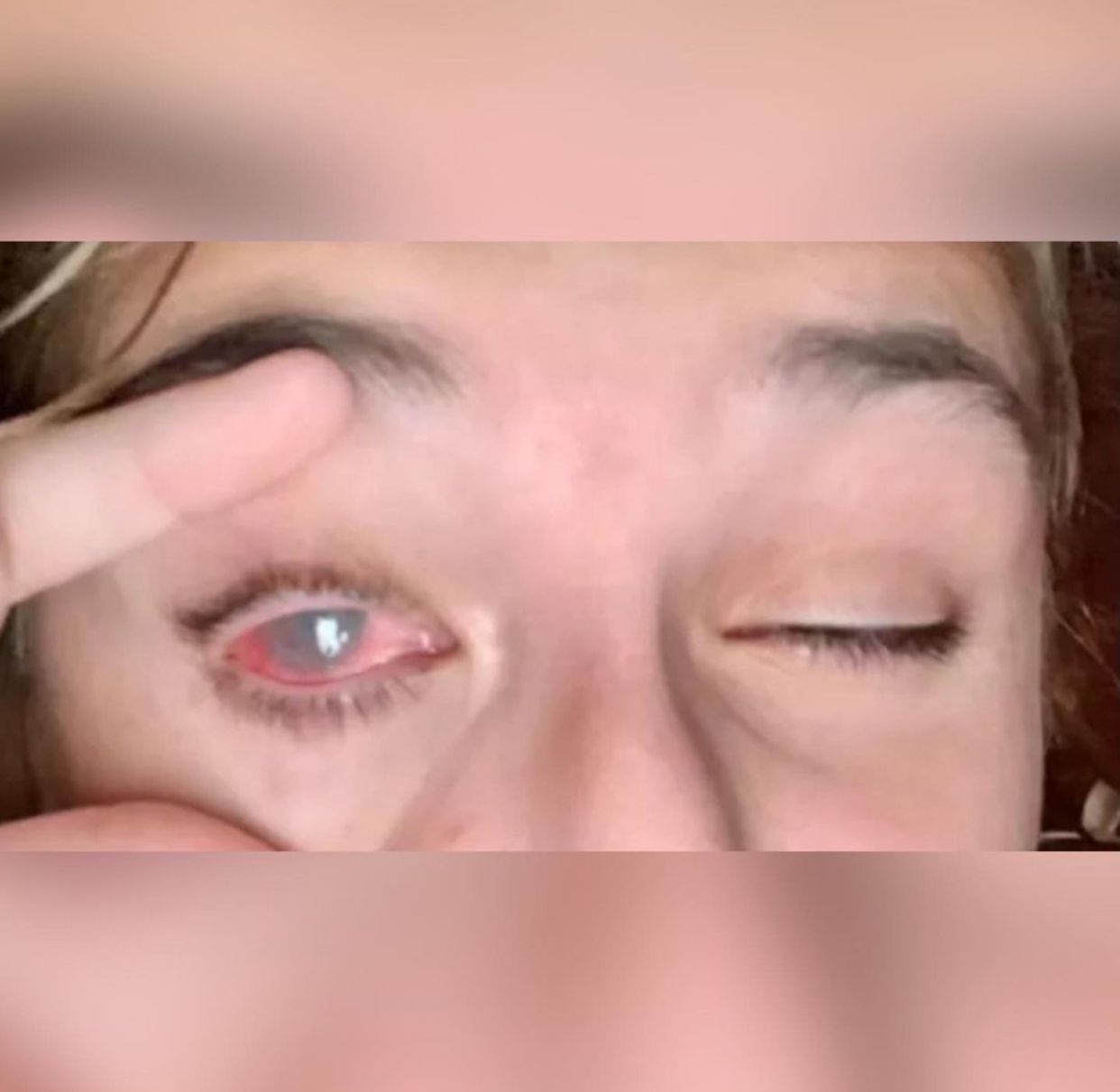 Adolescente fica cega após tubo de tintura para cabelo explodir nos EUA (Foto: Reprodução - Redes sociais)