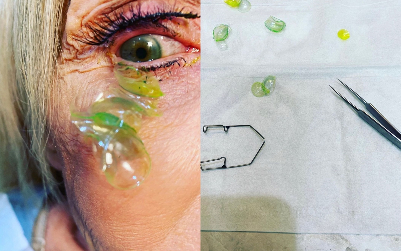 Vídeo mostra médica removendo 23 lentes de contato de olho de paciente (Fotos: reprodução/Instagram)