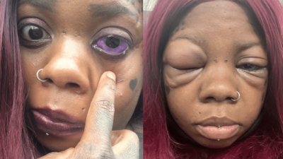 Anaya Peterson tem compartilhado o caso nas redes sociais Mulher tatua globos oculares e corre risco de perder a visão; vídeo