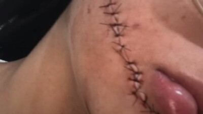 Estudante de enfermagem precisou levar 18 pontos no corte Jovem é esfaqueada enquanto dormia em ônibus na Bahia