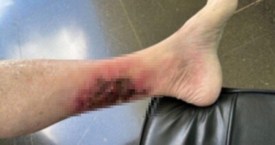 Carlos publica foto da perna de Bolsonaro com erisipela