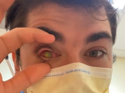 Americano desenvolveu uma infecção grave da córnea Homem fica cego de um olho depois de dormir com lentes de contato