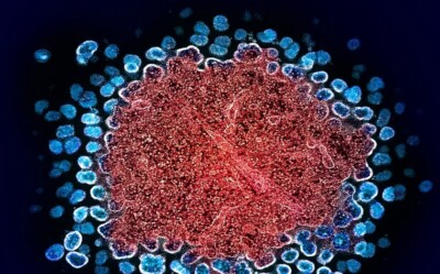HIV: cientistas anunciam novo caso de remissão, diferente dos anteriores Paciente também recebeu um transplante de medula óssea