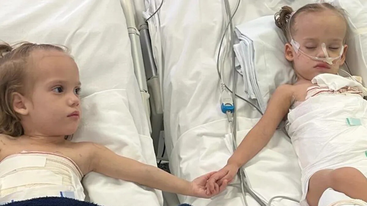 Valentina, siamesa operada em hospital de Goiânia, é extubada
