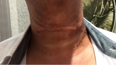 Motociclista tem o pescoço cortado e queimado por fio solto em rua de Mineiros