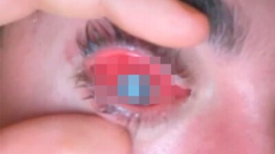 Mike Krumholz já havia sofrido com infecções oculares antes Homem tem olho devorado por parasita após dormir com lentes