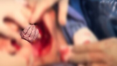 Após parto normal não dar certo, bebê segura na mão de médica durante cesariana em Anápolis