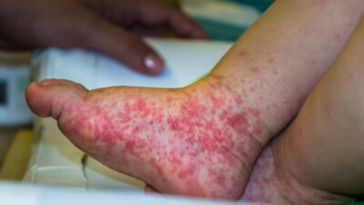 Goiás já tem mais de 400 casos confirmados da síndrome mão-pé-boca Enfermidade contagiosa é causada pelo vírus Coxsackie