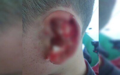 Aluno autista tem pedaço da orelha arrancado durante briga em escola, em Goiandira O caso é investigado pela Polícia Civil (PC)