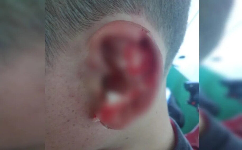 Aluno autista tem pedaço da orelha arrancado durante briga em escola, em Goiandira O caso é investigado pela Polícia Civil (PC)
