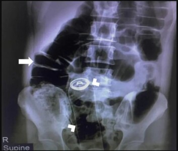Iraniano passa por cirurgia para retirar desodorante do estômago depois de usá-lo como objeto sexual entenda os riscos desse tipo de prática