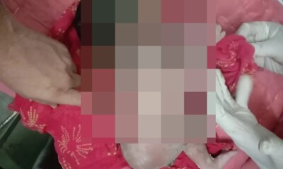 Bebê na Índia nasce com um terceiro braço crescendo nas costas; veja foto Os médicos o diagnosticaram com polimelia