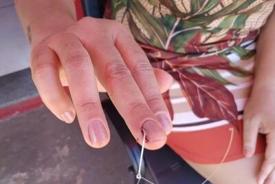 Mulher atravessa dedo com anzol de pesca em Jataí