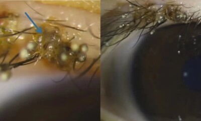 Menino de 3 anos sofre com infestação de piolhos nos cílios após brincar na areia casos de piolho nos cílios são extremamente raros