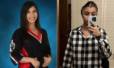 Infecção de jovem com sinusite se espalha para o cérebro e metade do crânio é removida Natasha Gunther Santana sofreu cinco infecções