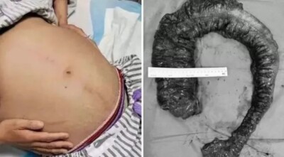 Paciente é submetida a cirurgia para retirar massa fecal de 1m e 20kg que endureceu após constipação dificuldades para evacuar