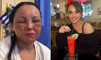 Eczema causa perda de visão temporária em jovem da Irlanda Beatrice Gaucahas ficou internada por conta do inchaço causado pela inflamação