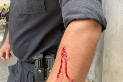 Braço de suspeito ferido após confronto (Foto: Divulgação)