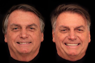 'Vaidade não faz mal a ninguém', diz Bolsonaro ao colocar lentes de contato nos dentes Ex-presidente em uma clínica de Goiânia