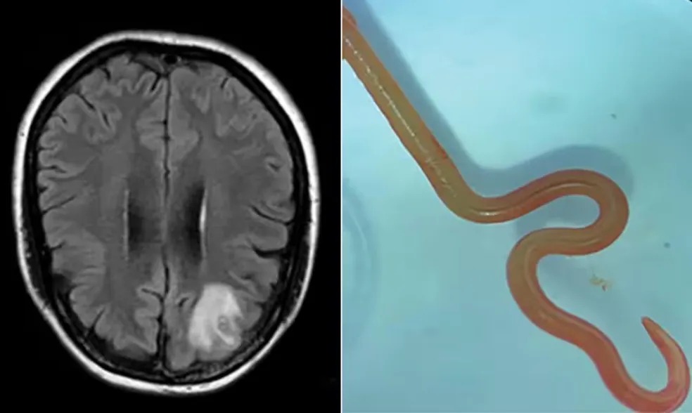 Médicos encontram pela primeira vez verme parasita vivo no cérebro de uma mulher, na Austrália Larva de sete centímetros é comum em cascavéis