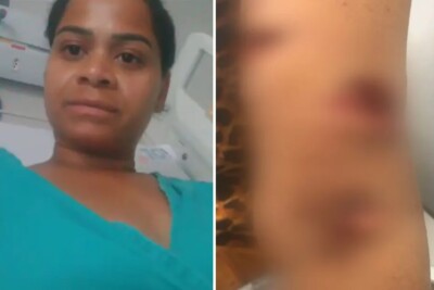 Mulher atacada por três pit bulls, em Goianira, deixa hospital; polícia investiga o caso