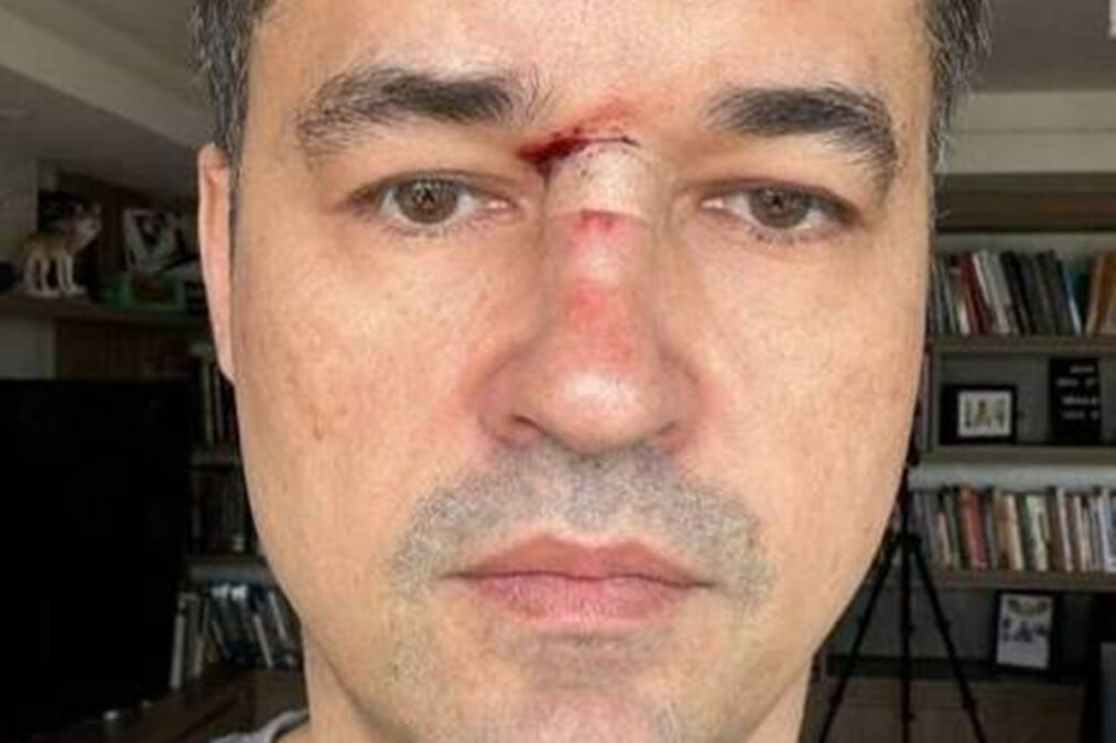 Deltan posta foto com o rosto machucado para criar mistério, mas relata tombo