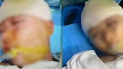 Professor é preso após agredir aluna com régua e causar traumatismo craniano Pai da menina informou que ela continua em estado grave na UTI