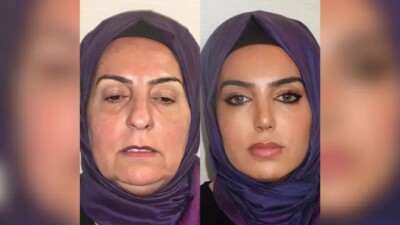 Resultado levantou dúvidas sobre veracidade do pós-cirúrgico Antes e depois de plástica em idosa na Turquia causa polêmica