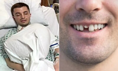 Homem quebra dente, não trata e quase morre após contrair infecção e precisar operar coração Ele não tinha um plano de saúde bom