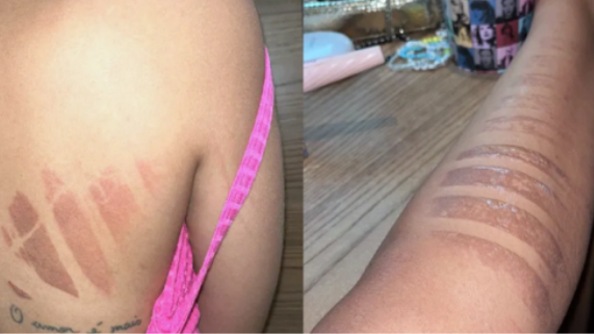 Fã sofre queimaduras de segundo grau após queda em show de Taylor Swift (Foto: Arquivo Pessoal).