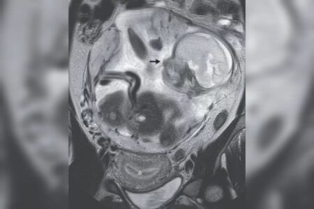 Mulher com cólicas vai ao médico e descobre gestação no abdômen, na França Bebê estava em formação há 23 semanas