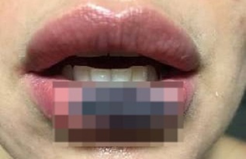 Mulher vendia abertamente as cirurgias em seu Instagram Dentista que deformou rosto de pacientes é presa em Goiânia